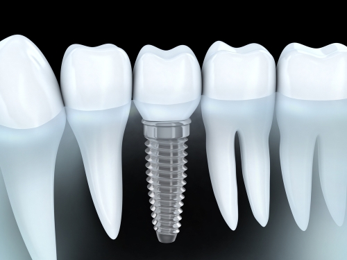 Dental-Implants web